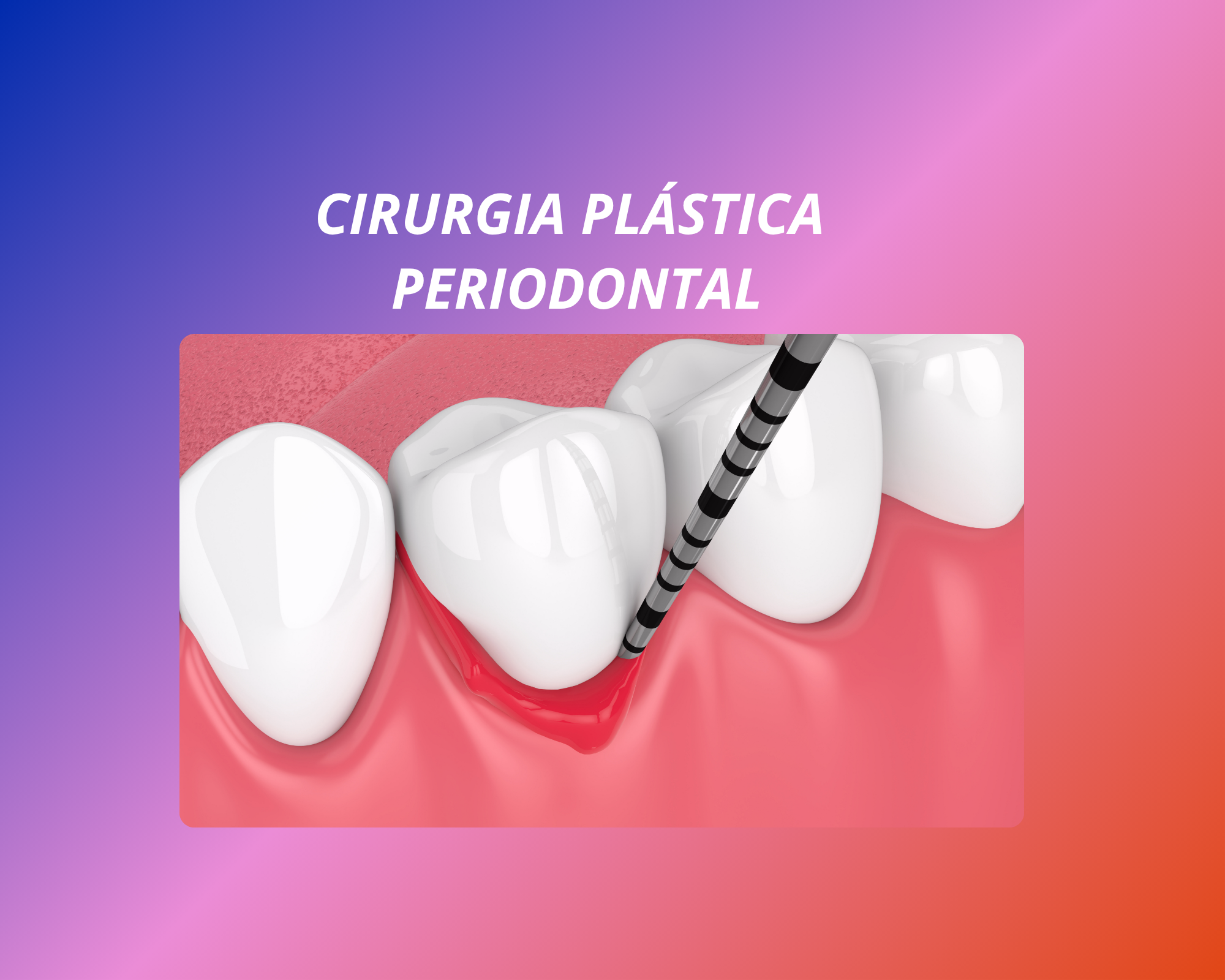 Curso de Atualização em Cirurgias Plásticas Periodontais 2026/1